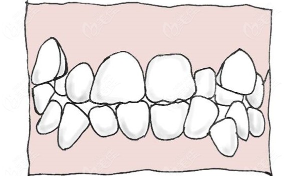 牙列拥挤牙齿不齐的症状