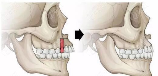 骨性凸嘴做正颌手术示意图
