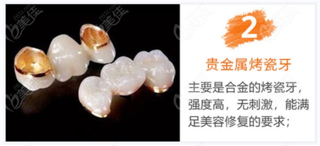 贵金属烤瓷牙优缺点