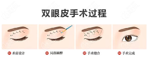 日式无痕双眼皮手术操作过程示意图