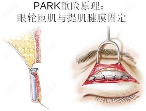 kiss法双眼皮图片