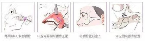 颧骨内推原理