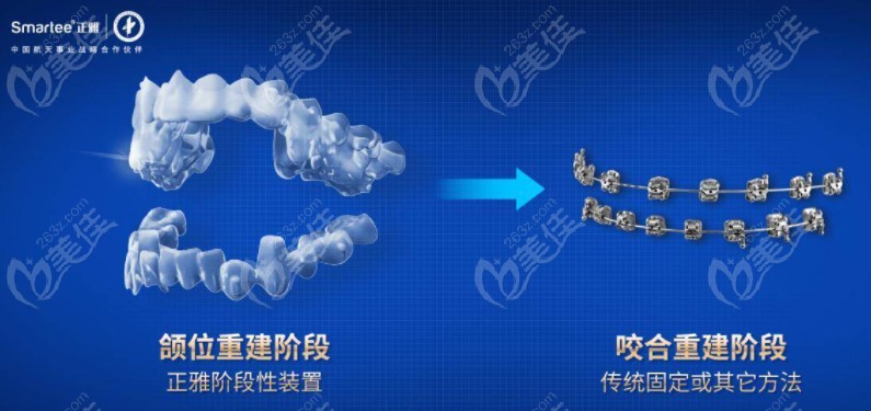  正雅s8頜位重建多少錢(qián)