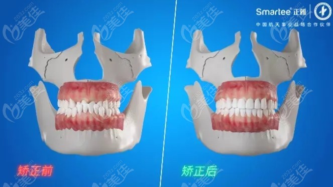 正雅s8矯正成功案病例
