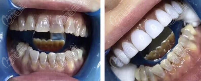 浮雕牙的美觀度很低