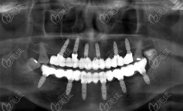 全口无牙在昆明美奥口腔选择allon6种植牙方案成功修复满口牙