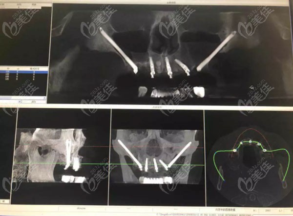 41岁大哥在杭州美奥口腔做上半口穿颧骨种植牙,避免了上颌窦提升和植骨手术