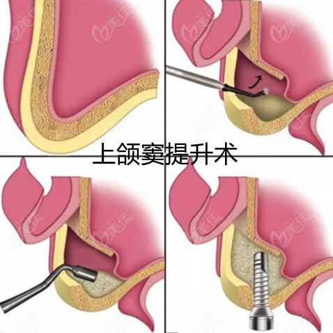 上颌窦提升手术模拟