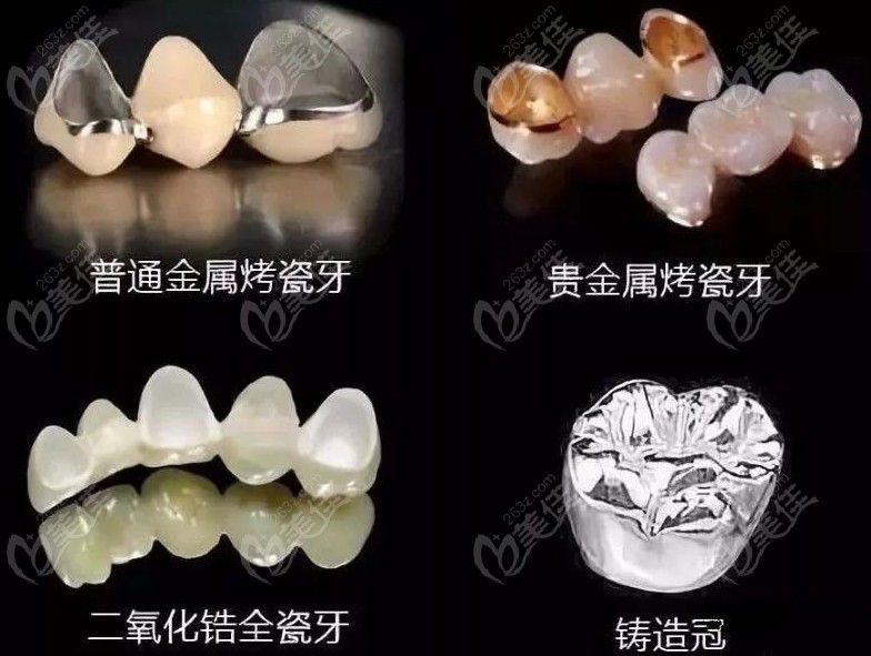金属烤瓷牙、贵金属烤瓷牙、全瓷牙等区别