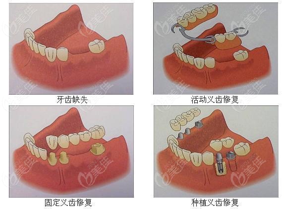 看看牙齿缺失修复的方式有哪些吧