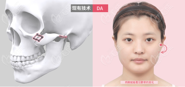韩国DA医院Turning颧骨缩小术相比传统颧骨手术的优势