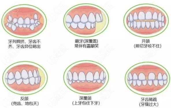 牙齿畸形类型图