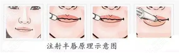 玻尿酸注射M唇手术过程示意图
