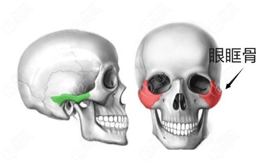 上眼眶骨头突出可以磨骨吗那做眼眶骨整形得多少钱呀