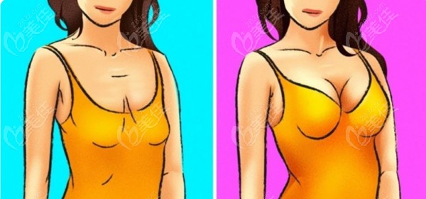乳房整形 对比图片