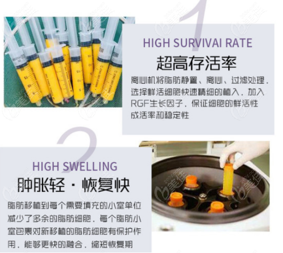 徐茂武醫(yī)生自體脂肪填充的優(yōu)勢(shì) 徐茂武醫(yī)生自體脂肪填充的優(yōu)勢(shì)