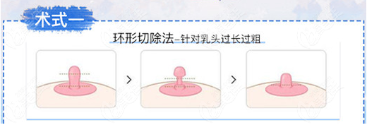 天津时光乳头缩小手术方式环形切除法
