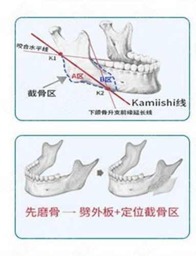 南宁爱思特做下颌角的优势