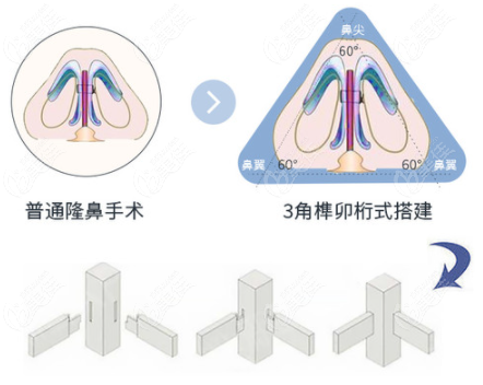 肋软骨隆鼻支架图解图片