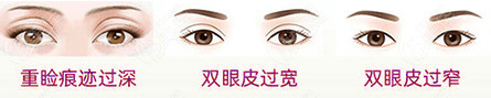 株洲韩美除了埋线双眼皮修复能做双眼皮过宽等也不错