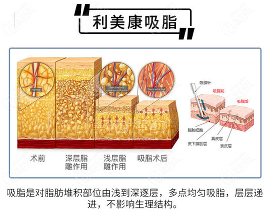 <!--<i data=20240703-sp></i>-->鲁天宇医生吸脂技术 <!--<i data=20240703-sp></i>-->鲁天宇医生吸脂技术