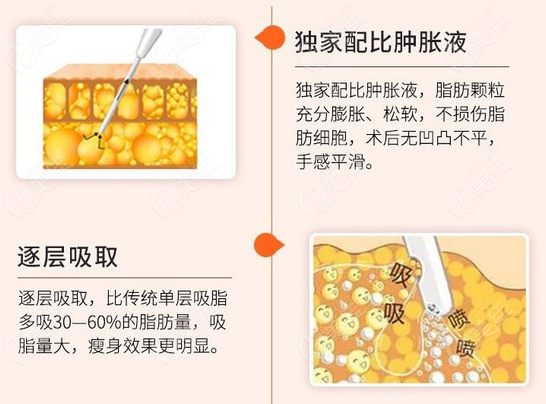 贵阳美贝尔医院做面部吸脂技术  贵阳美贝尔医院做面部吸脂技术