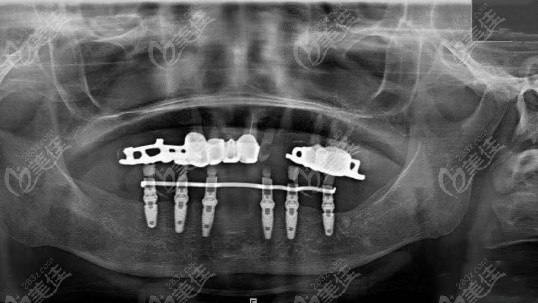 60岁老人刚做完的allon6下半口种植牙病例