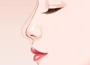 宁波艺星做鼻综合怎么样