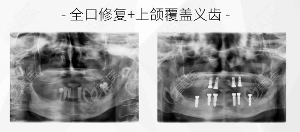 到雅莱齿科做全口修复+上颌覆盖义齿前后对比图