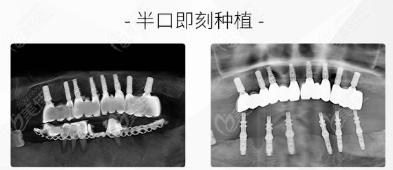 到雅莱齿科做半口即刻种植前后对比图