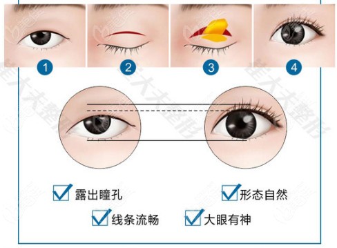 帕克法双眼皮图片