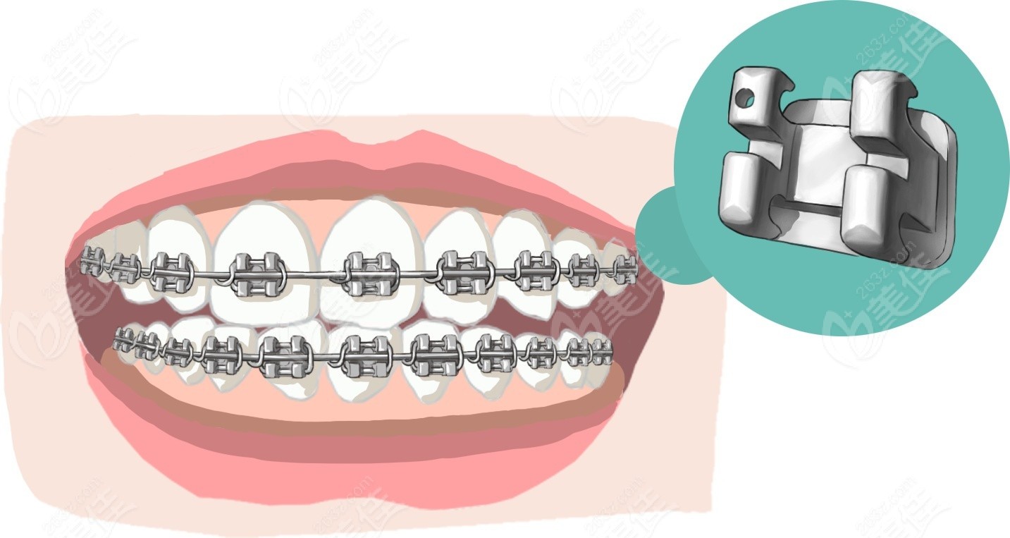 使用传统金属矫治器矫正龅牙