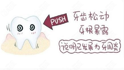 牙周炎治疗5000贵吗