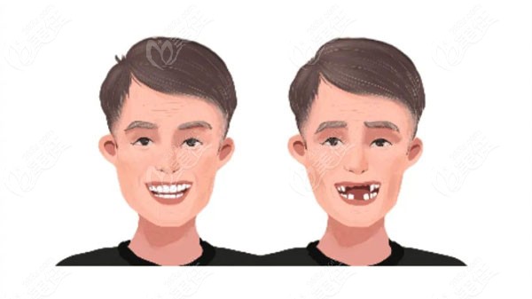王先生40岁时患了牙周病，得知有种牙补贴后做了allon4+6全口种植