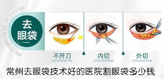 常州去眼袋医院割眼袋多少钱