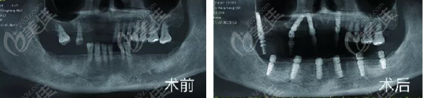 满口种植牙前后照片对比