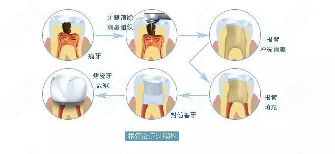 根管治疗的步骤过程图片