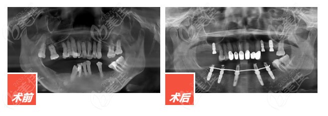 All-on-N系列下颌即刻种植+上颌常规种植前后对比图