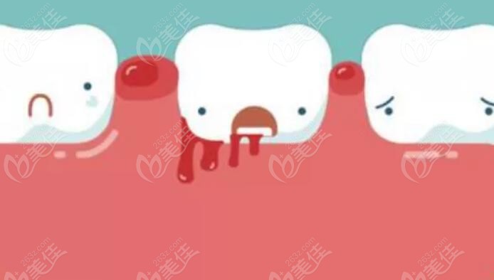 牙龈出血色征兆