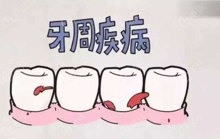 牙周疾病导致的口腔问题