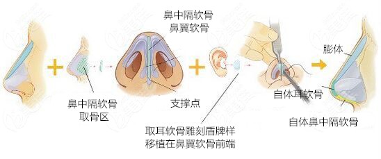 <i data-id='bf2f3548-2467-4090-a75e-9e24967ac3c0' style='display:none;'></i>主做鼻综合