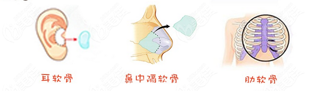 鼻综合中常用的自体软骨材料