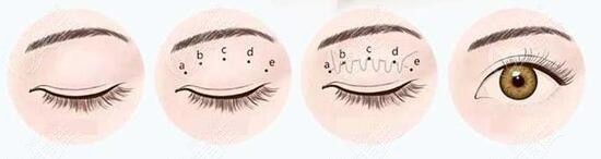 酒泉华美整形杨艳医生做埋线双眼皮手术 酒泉华美整形杨艳医生做埋线双眼皮手术