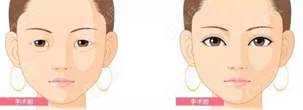 酒泉华美整形杨艳医生做埋线双眼皮对比 酒泉华美整形杨艳医生做埋线双眼皮对比