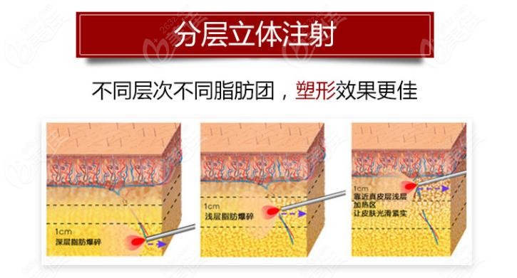 医生会根据你脸型的饱满程度,通过(深层,中层,浅层)不同层次,不同脂肪