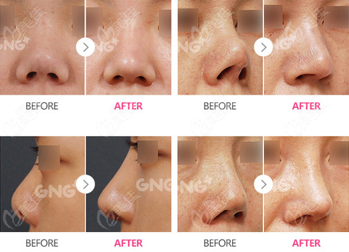 韩国GNG整形外科鼻挛缩修复对比图
