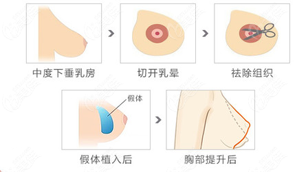 中度乳房下垂矫正方法