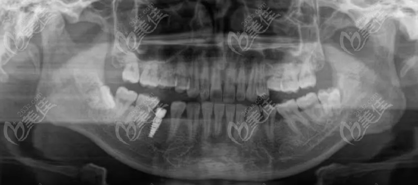 这是种完当天拍的牙齿CT