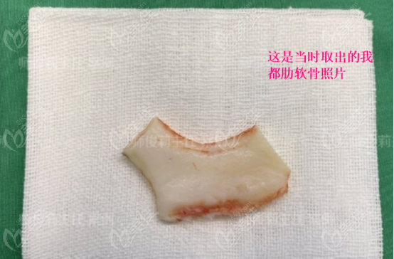 師俊莉醫(yī)生取出的肋軟骨