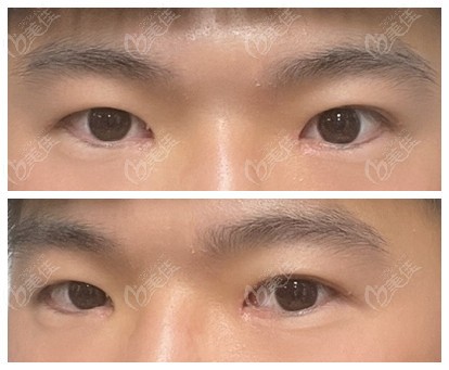 男生割双眼皮前后对比照片分享：肉泡眼做的5毫米全切双眼皮+提肌+开内眼角还挺好看的